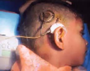 Гухим детям делают кохлеарную имплантацию - возвращают способность слышать