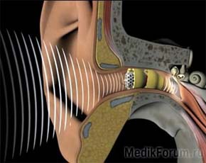 "Лиричный" невидимый слуховой аппарат