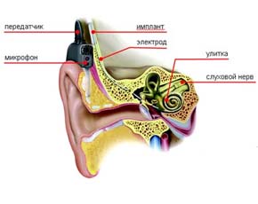 Глухие против кохлеарной имплантации?