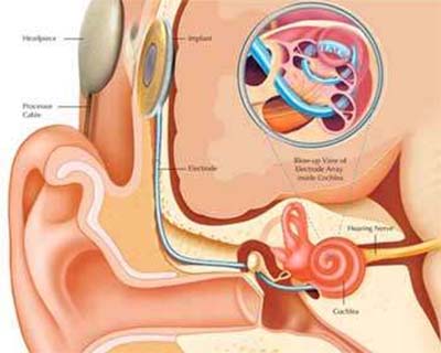 С помощью кохлеарного импланта выращивают клетки слухового нерва