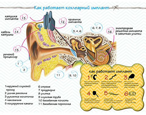 В Челябинске врачи научились делать кохлеарную имплантацию